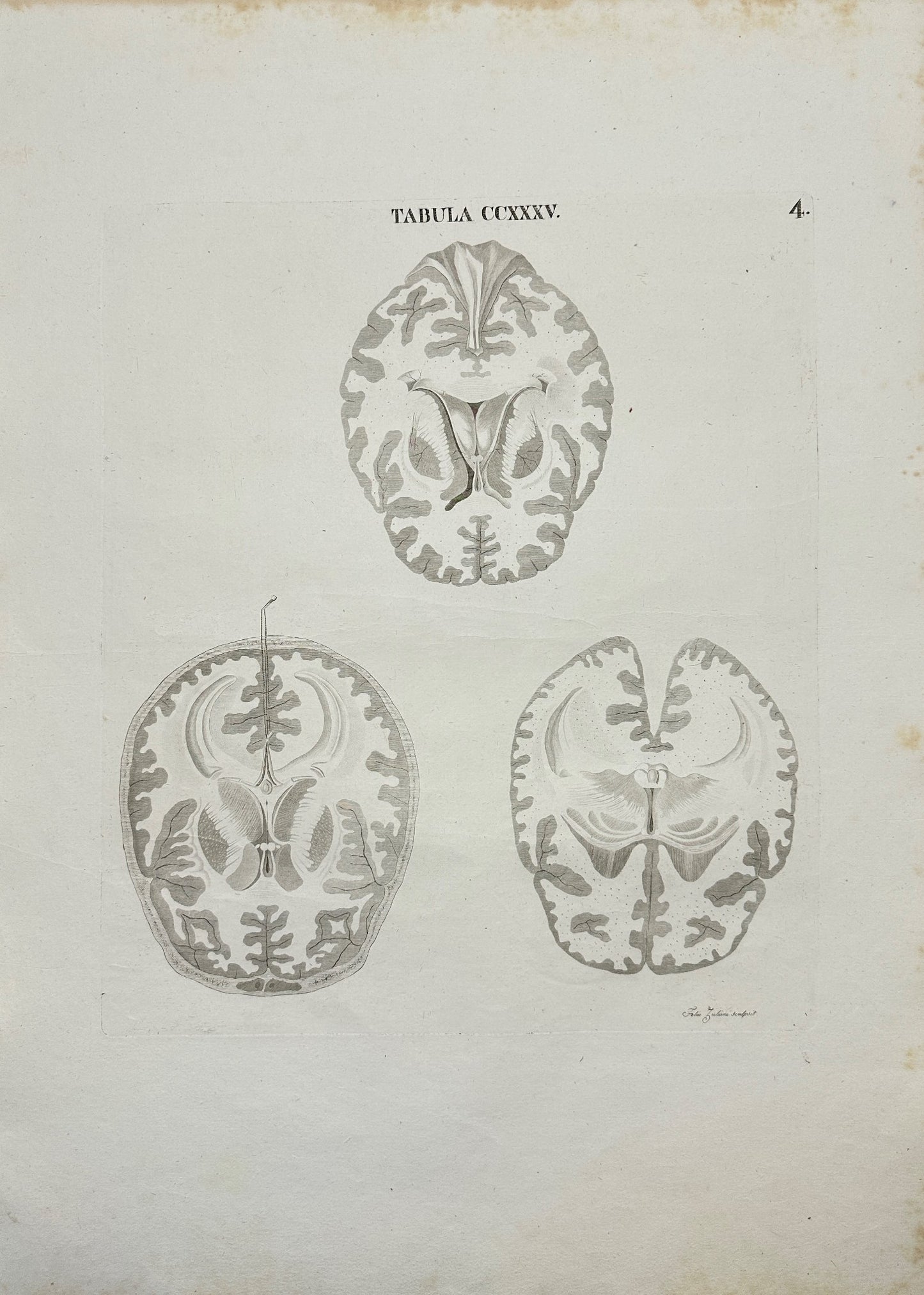 Original Antique Print - Caldani - Female Brain Sectioned Vertically - F4